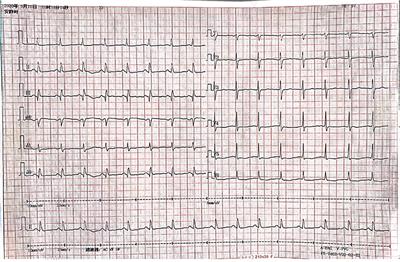 A Case Report: An Elderly Male Patient With Takayasu Arteritis After Coronary Artery Bypass Grafting